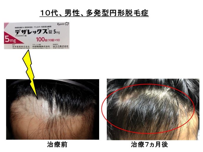 円形脱毛症　病院